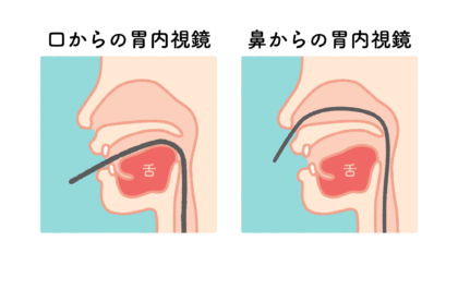 極細のスコープで口と鼻どちらでも楽な検査が可能